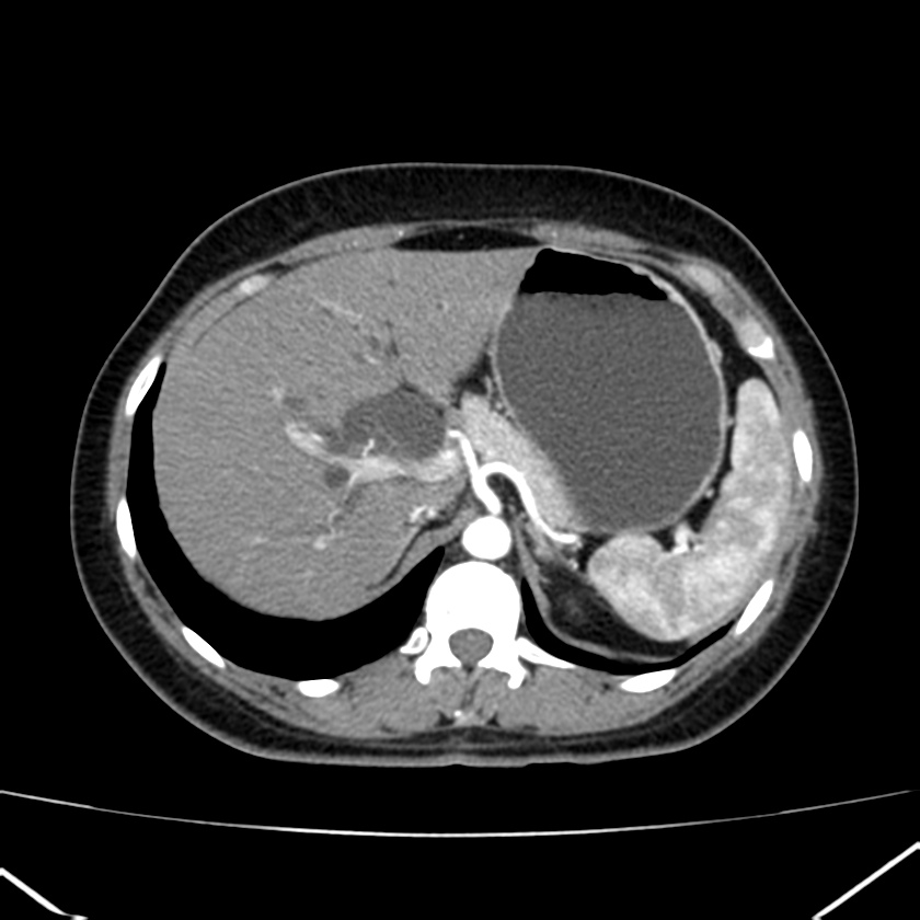 Ampullary tumor (Radiopaedia 22787-22816 B 23).jpg