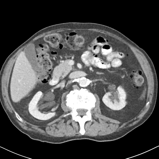 File:Amyand hernia (Radiopaedia 39300-41547 A 24).png