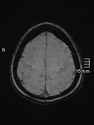 File:Amyotrophic lateral sclerosis (Radiopaedia 70821-81017 Axial SWI 47).jpg