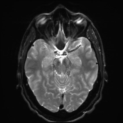 File:Amyotrophic lateral sclerosis (Radiopaedia 87352-103658 Axial DWI 10).jpg