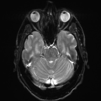 File:Amyotrophic lateral sclerosis (Radiopaedia 87352-103658 Axial DWI 8).jpg