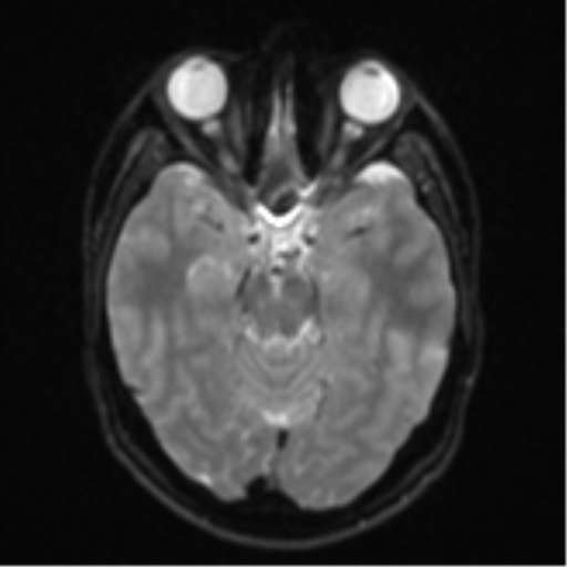 Anaplastic astrocytoma (Radiopaedia 57768-64731 Axial DWI 10).png