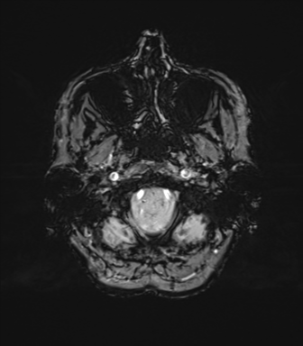 Anaplastic astrocytoma (Radiopaedia 86943-103160 Axial SWI 13).png