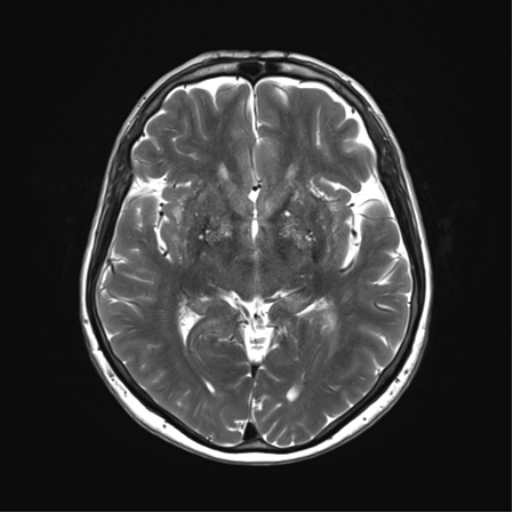 File:Anaplastic astrocytoma (Radiopaedia 86943-103160 Axial T2 19).png