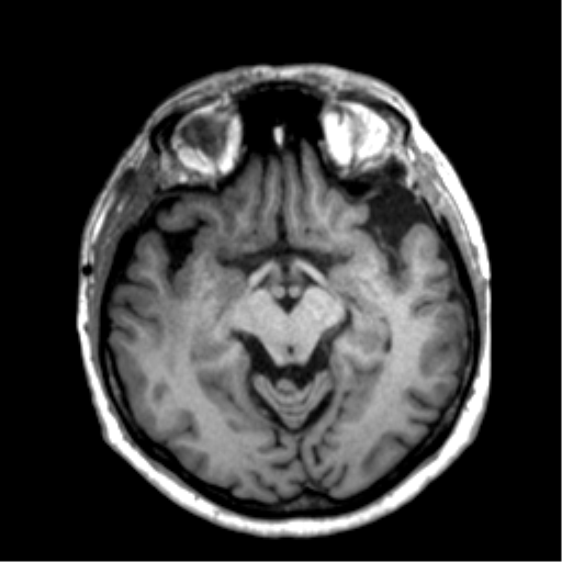 Anaplastic astrocytoma IDH wild-type (pseudoprogression) (Radiopaedia 42209-45277 Axial T1 55).png