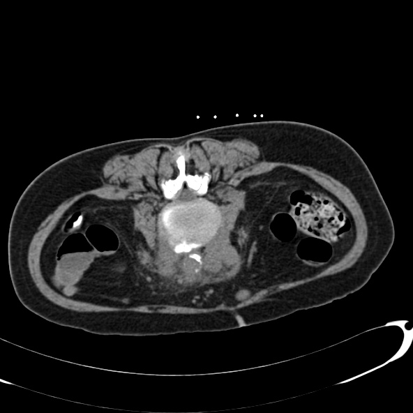 Anaplastic lymphoma - with CT biopsy (Radiopaedia 21643-21602 Axial non-contrast 50).jpg