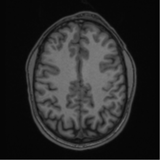 Anaplastic oligodendroglioma with skull fracture (Radiopaedia 74831-85845 Axial T1 45).png