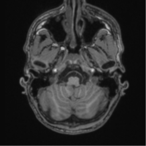 Anaplastic oligodendroglioma with skull fracture (Radiopaedia 74831-85845 Axial T1 6).png