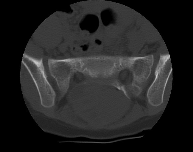 Aneurysmal bone cyst - sacrum (Radiopaedia 65190-74195 Axial bone window 21).jpg