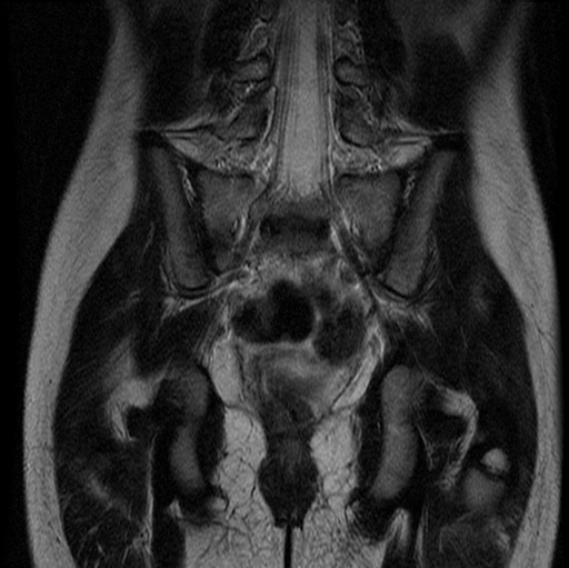 File:Aneurysmal bone cyst - sacrum (Radiopaedia 65190-74196 Coronal T2 13).jpg