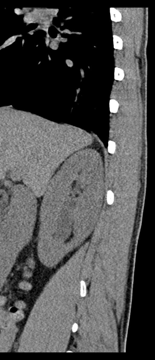 Aneurysmal bone cyst T11 (Radiopaedia 29294-29721 E 73).jpg