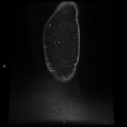 Angioleiomyoma (Radiopaedia 85442-101078 F 12).jpg