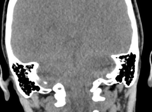 Angular dermoid cyst (Radiopaedia 88967-105790 Coronal non-contrast 88).jpg