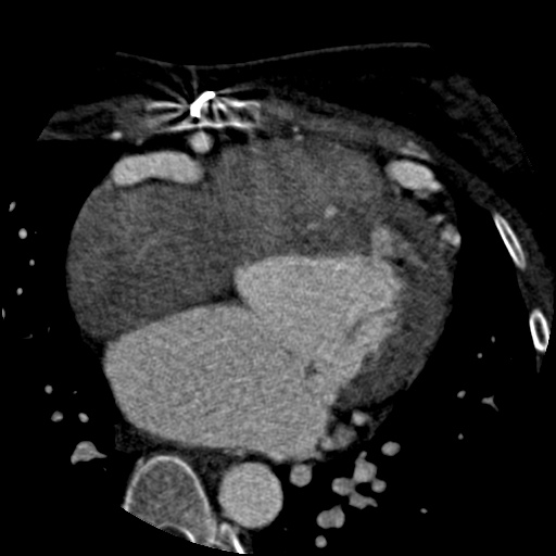 Anomalous left coronary artery from the pulmonary artery (ALCAPA) (Radiopaedia 40884-43586 A 39).jpg