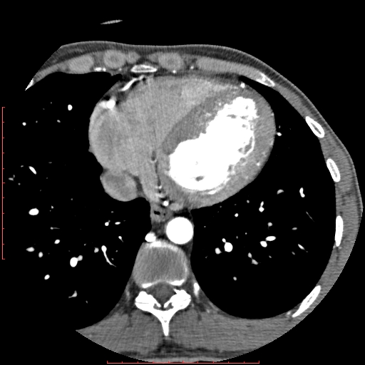 Anomalous left coronary artery from the pulmonary artery (ALCAPA) (Radiopaedia 70148-80181 A 267).jpg