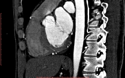File:Anomalous left coronary artery from the pulmonary artery (ALCAPA) (Radiopaedia 70148-80181 C 137).jpg