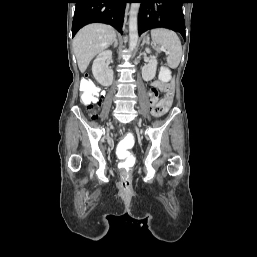 Anorectal carcinoma (Radiopaedia 44413-48064 B 53).jpg