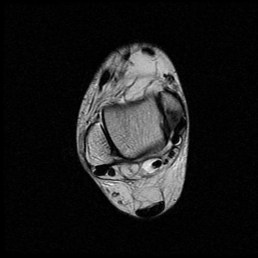 File:Anterior calcaneal process fracture (Radiopaedia 71377-81705 Axial T2 6).jpg