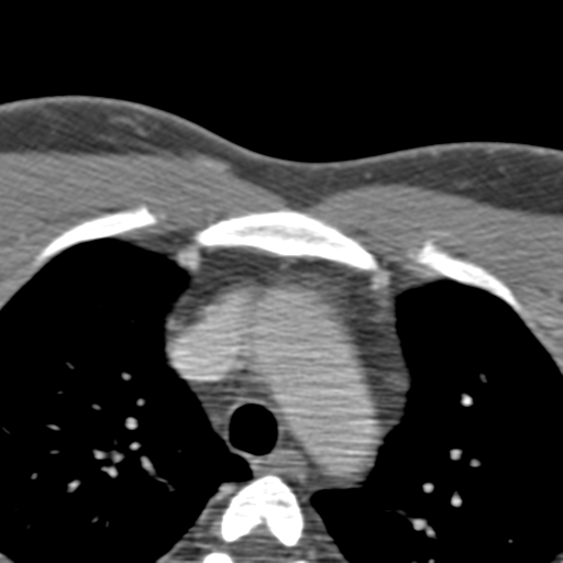 Anterior cerebral artery territory infarct (Radiopaedia 39327-41581 B 113).png