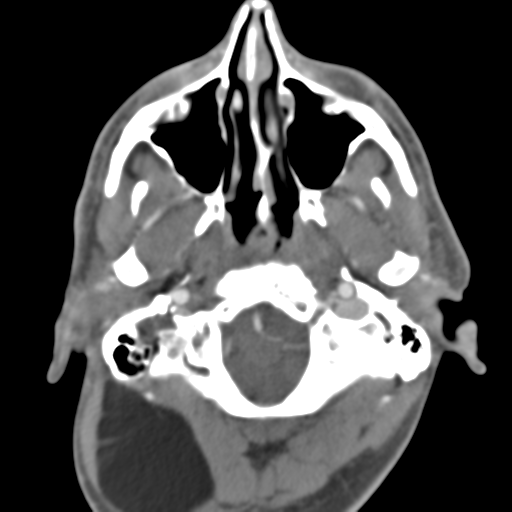 File:Anterior cerebral artery territory infarct (Radiopaedia 39327-41581 B 50).png