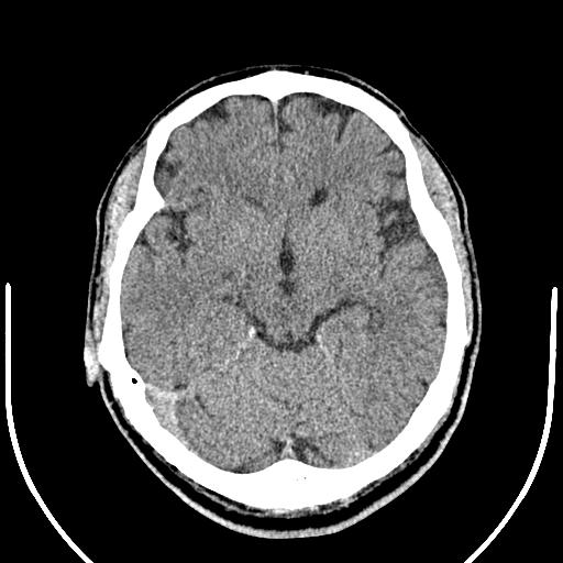Anterior choroidal artery infarct (Radiopaedia 55106-61480 Axial non-contrast 22).jpg