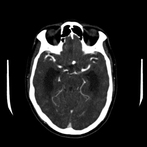 File:Anterior communicating artery aneurysm (Radiopaedia 16633-16335 A 17).jpg