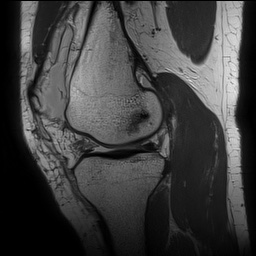 Anterior cruciate ligament rupture with Segond fracture (Radiopaedia 69043-78806 Sagittal PD 75).jpg