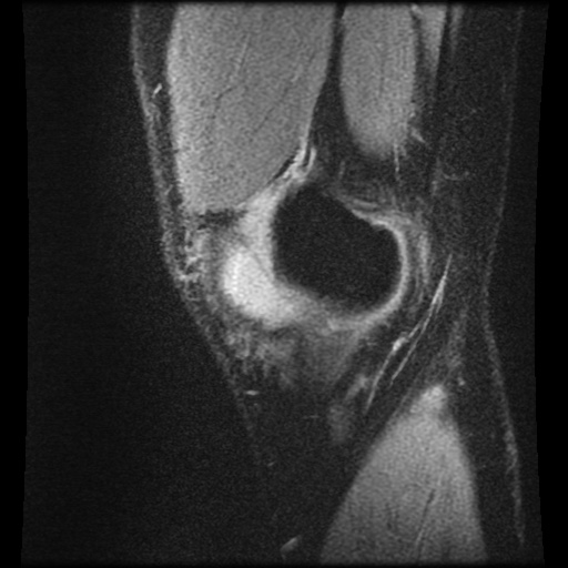 File:Anterior cruciate ligament tear (Radiopaedia 61500-69462 F 3).jpg