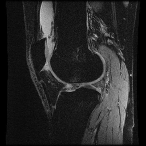 Anterior cruciate ligament tear (Radiopaedia 61500-69462 F 58).jpg