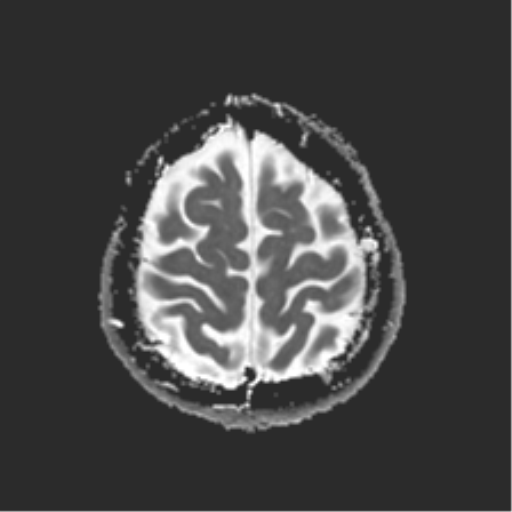 File:Anterior temporal lobe perivascular space (Radiopaedia 40946-43650 Axial ADC 24).png