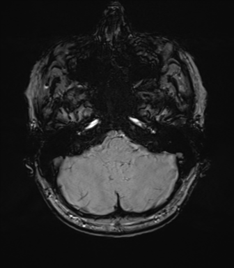 Anterior temporal lobe perivascular space (Radiopaedia 40946-43650 Axial SWI 16).png