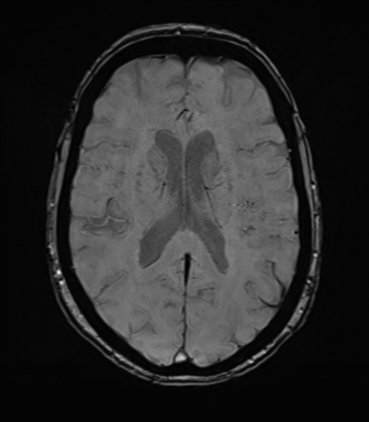 Anterior temporal pole cysts (Radiopaedia 46629-51102 Axial SWI 52).png