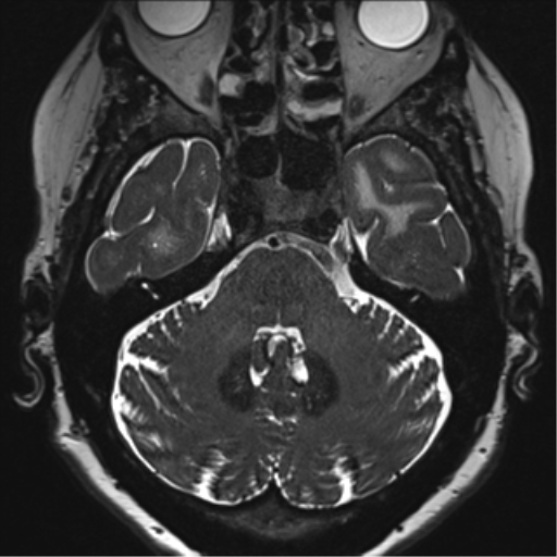 Anterior temporal pole cysts (Radiopaedia 46629-51102 Axial T2 42).png