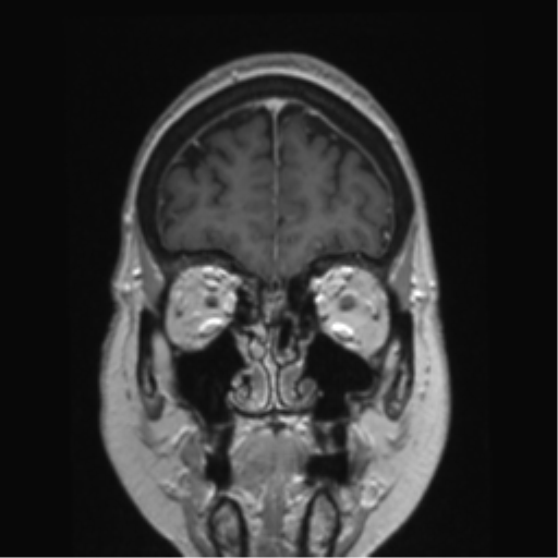 Anterior temporal pole cysts (Radiopaedia 46629-51102 Coronal T1 C+ 143).png