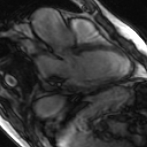 File:Anteroseptal hypokinesia after myocardial infarction (Radiopaedia 15978-15633 3 chamber view SSFE 18).jpg