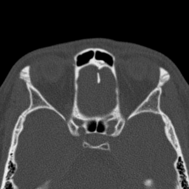 Antrochoanal polyp (Radiopaedia 33984-35202 Axial bone window 61).jpg