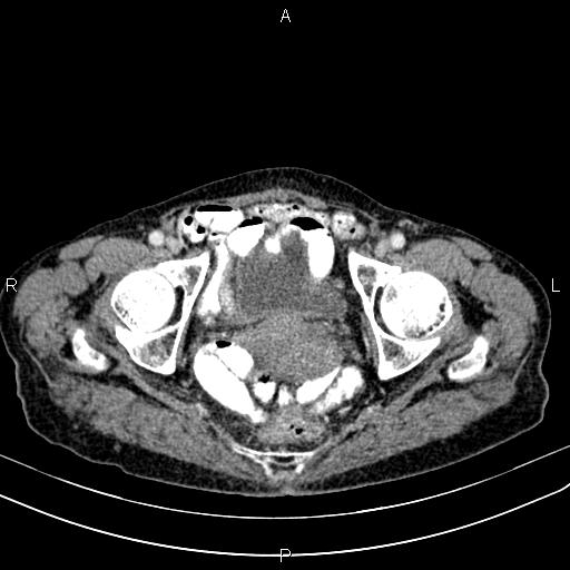 File:Aortic aneurysm and Lemmel syndrome (Radiopaedia 86499-102554 A 74).jpg