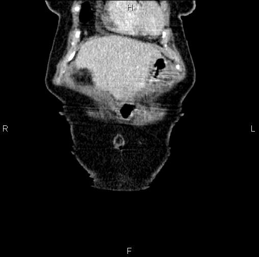 Aortic aneurysm and Lemmel syndrome (Radiopaedia 86499-102554 C 3).jpg