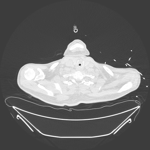 Aortic arch aneurysm (Radiopaedia 84109-99365 Axial lung window 26).jpg