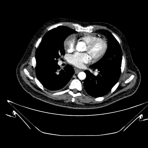 Aortic arch aneurysm (Radiopaedia 84109-99365 B 347).jpg