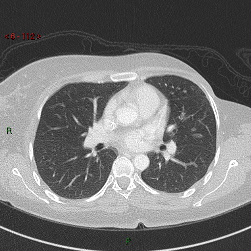 Aortic arch origin of left vertebral artery (Radiopaedia 51520-57286 Axial lung window 112).jpg