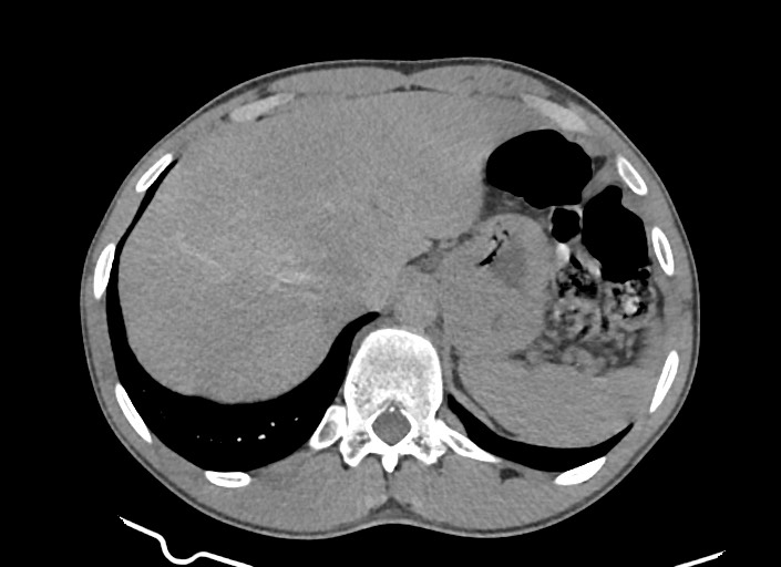 File:Aortic coarctation with aneurysm (Radiopaedia 74818-85828 A 38).jpg