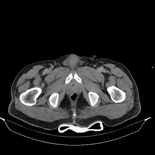 File:Aortic dissection- Stanford type A (Radiopaedia 22085-22085 Axial C+ delayed 56).jpg