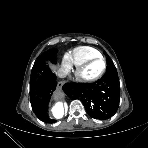Aortic dissection (Radiopaedia 27466-27665 C+ arterial phase 219).jpg
