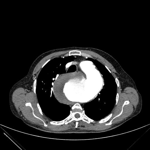 Aortic dissection (Radiopaedia 27466-27665 C+ arterial phase 53).jpg