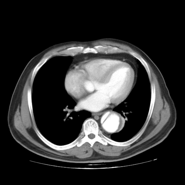 Aortic dissection (Radiopaedia 44411-48061 C 17).jpg