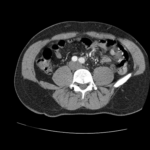 File:Aortic dissection - Stanford A -DeBakey I (Radiopaedia 28339-28587 B 161).jpg