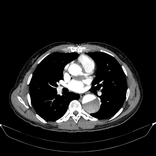 File:Aortic dissection - Stanford type A (Radiopaedia 83418-98500 A 33).jpg