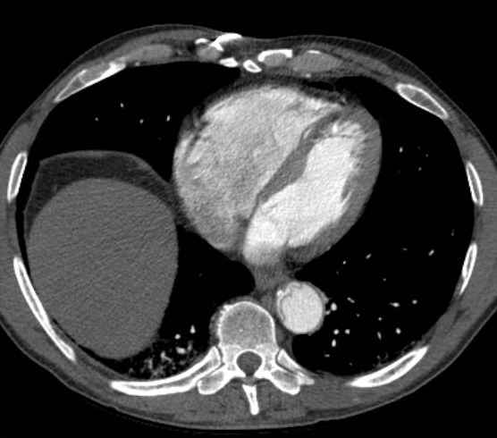 File:Aortic dissection - Stanford type B (Radiopaedia 73648-84437 A 80).jpg