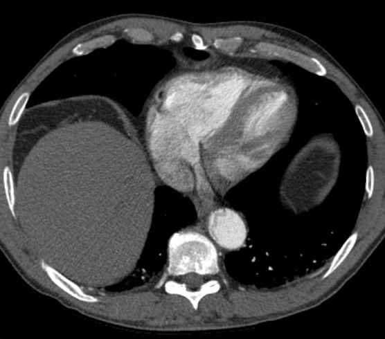 Aortic dissection - Stanford type B (Radiopaedia 73648-84437 A 87).jpg